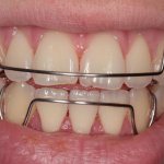 What are retainers used for?