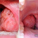 Holes in the tonsils: what are they? Causes and treatment. How to get rid of it? 