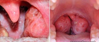 Holes in the tonsils: what are they? Causes and treatment. How to get rid of it?
