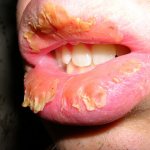 Эксфолиативный хейлит