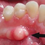 Exostosis of the gums: causes and treatment