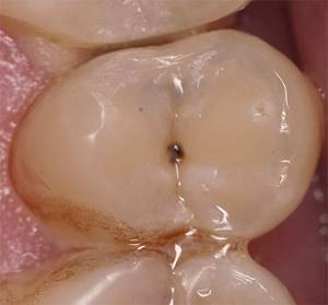Еще один пример, когда необходима дополнительная диагностика с целью уточнить, нет ли внутри зуба скрытого кариеса.