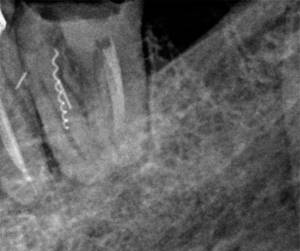 Еще один снимок, на котором хорошо видно кусочек застрявшего в канале стоматологического инструмента.