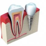 Есть ли ограничения к имплантации без костной пластики