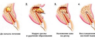 этапы цистэктомии гранулемы зуба