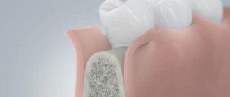 Этапы имплантации зубов без костной пластики