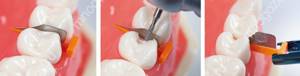 Этапы операции по сепарации зубов
