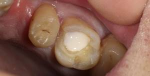 Этапы проведения домашней пломбировки зуба