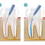 этапы реставрации зубов