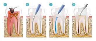 stages of dental restoration