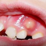 флюс у ребенка