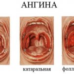 Фолликулярная ангина