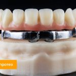 Фото балочного протеза на имплантах