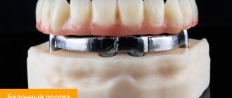 Photo of a beam prosthesis on implants