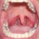 Фото болезни горла