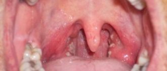 Фото болезни горла