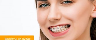 Photo of braces on the teeth of the upper jaw
