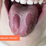 Фото десквамативного глоссита