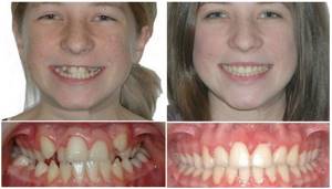Фото до и после лечения брекетами