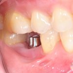 Фото импланта зуба