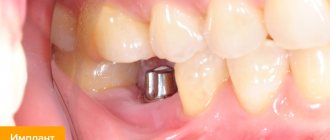 Photo of a dental implant