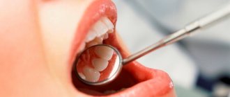 Photo: How to prevent epulis from appearing on the gums