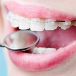 Фото керамических брекетов на зубах пациентов