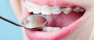 Фото керамических брекетов на зубах пациентов