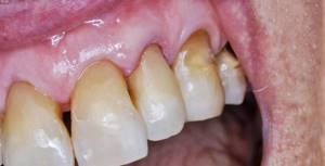 Фото: клиновидный дефект на верхних зубах