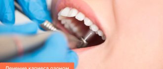 Photo of caries treatment with ozone