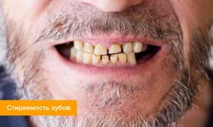 Фото мужчины, который страдает стираемостью зубов