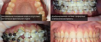 Фото на разных этапах лечения безлигатурными брекетами