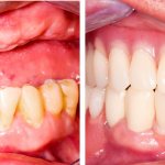 Photo of the patient before and after installation of a partial removable denture