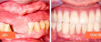 Photo of the patient before and after installation of a partial removable denture