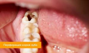 Фото перфорации корня зуба во рту у пациента