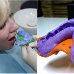 Photo of creating a veneer impression