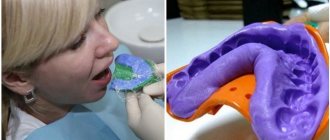 Photo of creating a veneer impression