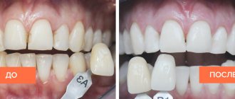 Фото зубов до и после отбеливания