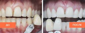 Фото зубов до и после отбеливания