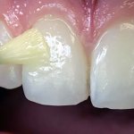 fluoridation of teeth