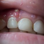 Герпес на десне