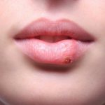 Герпес на губах у девушки