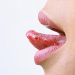 Герпес на языке
