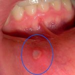 Herpes in the mouth (herpetic stomatitis), caused by a simple virus, is significantly different from the labial form of the disease, which is not rare