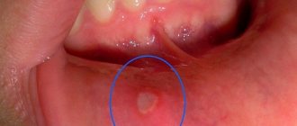 Герпес во рту (герпетический стоматит), вызываемый вирусом простого типа, существенно отличается от лабиальной формы заболевания, которое не является редким