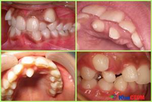 Гипердентия - аномалия числа зубов