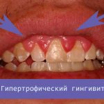 Hypertrophic gingivitis