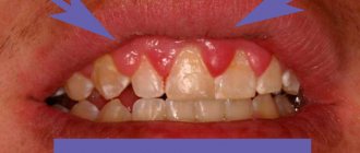 Гипертрофический гингивит