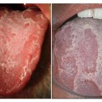 glossitis