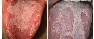 glossitis